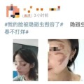 ‘로브 딱정벌레(隐翅虫)때문에 내 얼굴이 망가질뻔 했다’는 내용이 온라인에서 화제