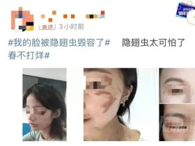 ‘로브 딱정벌레(隐翅虫)때문에 내 얼굴이 망가질뻔 했다’는 내용이 온라인에서 화제