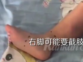 2세 남아, 시장에서 물고기 만지다 바이러스 감염돼 다리 절단 직전?